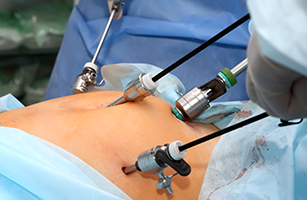 best laparoscopy treatment in hyderabad
